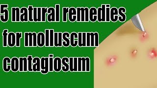 5 natural remedies for molluscum contagiosum  molluscum contagiosum Treatment [upl. by Chin]