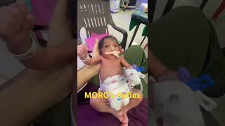 MOROs ReflexSee description👶👶 newborn parenting neonatologist AfterBirth afterbirth [upl. by Varini]