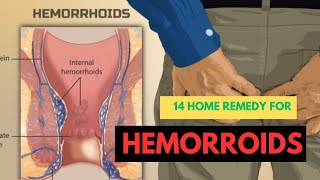 14 HOME REMEDIES FOR HEMORRHOIDS [upl. by Dihahs888]