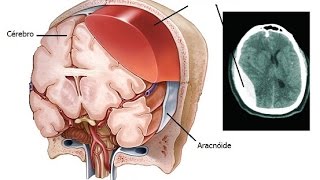 Subdural Hematoma [upl. by Nabroc867]