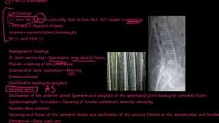 97P What is Ankylosing Spondylitis [upl. by Ogdan237]