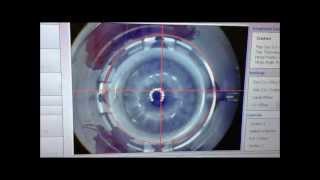 LASIK 100 laser with custom elliptical flap for astigmatism correction [upl. by Ralyks]