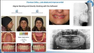 How to Improve Invisalign Clinchecks Quick Tip [upl. by Alimak]