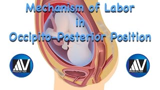 Mechanism of Labor in OccipitoPosterior Position [upl. by Penney528]