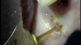 Tooth Extraction 1 with Waterlase [upl. by Seedman254]