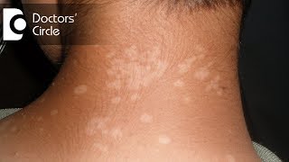 Pharmacological management of Tinea Versicolor in young individuals  Dr Urmila Nischal [upl. by Mirabelle]