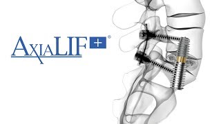 The AxiaLIF® L5S1 Spinal Fusion Procedure [upl. by Braswell]