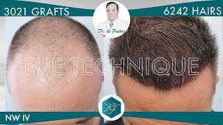 Hair Graft Technique FUE Grafts 3021 6242 Hairs [upl. by Suoicul411]