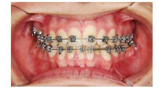 Self Ligating Braces dental Crowding Orthodontics [upl. by Alessandra715]