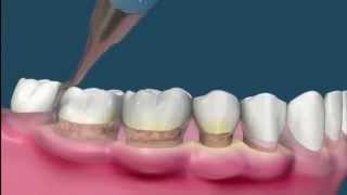 Raspado y alisado radicular  Periodoncia [upl. by Ydahs]