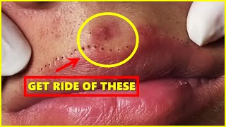 Lips Blackhead removal Video Blackheads blackheadsremoval sebum [upl. by Kermy233]