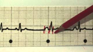 EKG für Pflege Teil 17  Supraventrikuläre Extrasystolen interpretieren SVES [upl. by Edouard22]