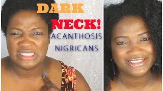 ACANTHOSIS NICRICANS DARK NECK and LAZY NATURAL MAKEUP NeziNapps [upl. by Ayel360]