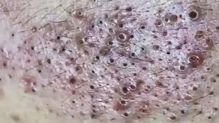 Blackheads amp Whiteheads Satisfying Removal 0274 [upl. by Auqinat877]