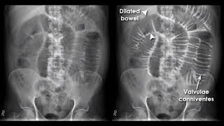 Radiological signs abdomen [upl. by Ancilin]