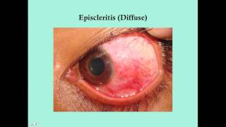 Scleritis  CRASH Medical Review Series [upl. by Hunter]