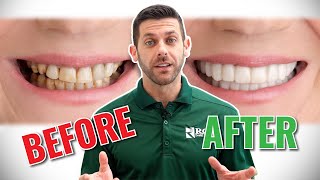 SnapOn Smile  ROEs Temporary Veneer Option for Dentists [upl. by Acessej]