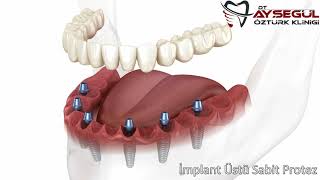 İmplant Üstü Sabit Protez [upl. by Naenej]