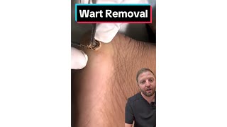 Wart Removal by Cauterizing Pain Free [upl. by Yehudit]