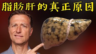 脂肪肝的真正原因自然療法柏格醫生 Dr Berg [upl. by Becky]