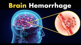 Brain Bleed Hemorrhage Intracranial Hemorrhage Pathology  Etiology Diagnosis amp Treatment [upl. by Meehahs]