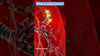 Understanding Lung Cancer Early Symptoms You Shouldnt Ignore [upl. by Esiralc347]