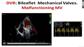 Prosthetic Heart Valve Echo by Dr Md Kabiruzzaman sir [upl. by Carolynne]