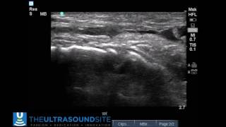 Tibialis Anterior Rupture II [upl. by Yorgo]