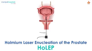 HoLEP 3 Olgu Holmium Laser Enucleation of the Prostate Case 3 [upl. by Ahsemac]