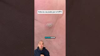 Esto no es un CALLO es VPH medicina Vph shorts [upl. by Mihsah]