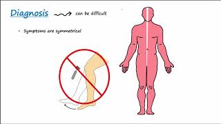 GuillainBarre Syndrome GBS Described Concisely [upl. by Maximilian403]