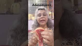 Adenomyosis of uterus health इनफॉर्मेशन [upl. by Tayler]