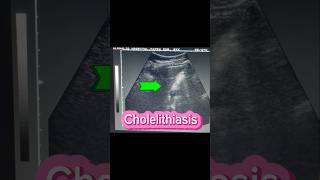 Stones in GB  Cholelithiasis  Cholecystitis  Gallstones  Fatty liver on Ultrasound [upl. by Etyak452]