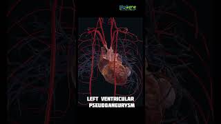 Postinfarction complications  trending shorts humanbiology biology doctor anatomy [upl. by Lenssen]