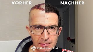 Haartransplantation Vorher Nachher  Elithairtransplant Ergebnisse [upl. by Aihsakal702]