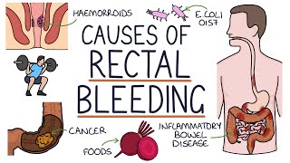 Understanding the Causes of Blood in Stool Rectal Bleeding [upl. by Cari302]