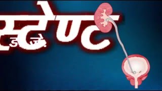 Patient information on D J Stent in HINDI [upl. by Gilboa]