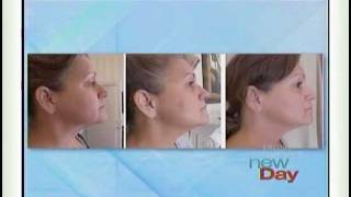 At Home Facelift Using The Face Wrap on KING TV Seattle [upl. by Ahsikal]