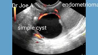 Endometrioma with simple cyst of same ovary ultrasound and color Doppler video [upl. by Oflodur42]