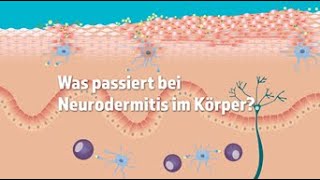 Was passiert bei Neurodermitis im Körper [upl. by Lumbye817]