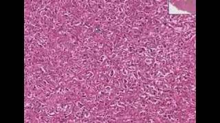 Histopathology AdrenalPheochromocytoma [upl. by Ila230]