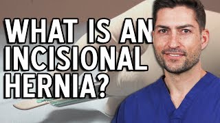 Incisional Hernia  What It Is and Why It Happens [upl. by Cybill]