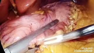 Laparoscopic sleeve gastrectomy and appendectomy for morbid obesity and appendicitis [upl. by Amery]