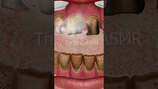 ASMR Teeth cleaning for longtime smokers [upl. by Narag]