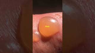 Fever Blisters Quick Tips to Heal Fast health healthy facts nutrition healthydiet [upl. by Abdel]