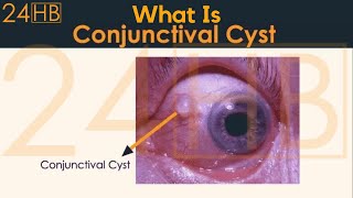 What Is Conjunctival Cyst  24HB [upl. by Harwilll]