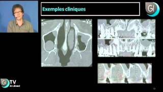 Implants dentaires  La physiopathologie du sinus maxillaire  Partie 2 [upl. by Sheba]