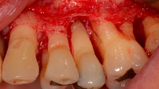 Treat Periodontal Gum Disease before placing Dental Implant [upl. by Tlok669]