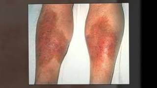 Skin Rashes On The Legs  Let Us Find The Cure [upl. by Enelime]