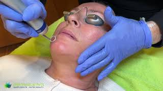 PicoWay Laser Facial at Well Medical Arts in Seattle [upl. by Ahtekal713]